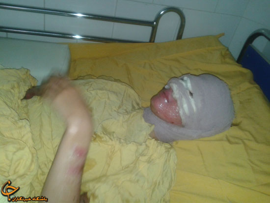 جنایت وحشیانه پدر و برادر/ اسیدپاشی بر صورت و بدن دختر 14 ساله! (+عکس)