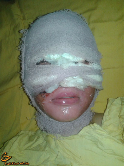 جنایت وحشیانه پدر و برادر/ اسیدپاشی بر صورت و بدن دختر 14 ساله! (+عکس)