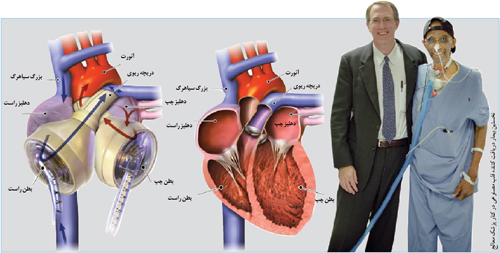 قلب مصنوعی چگونه کار می‌کند؟