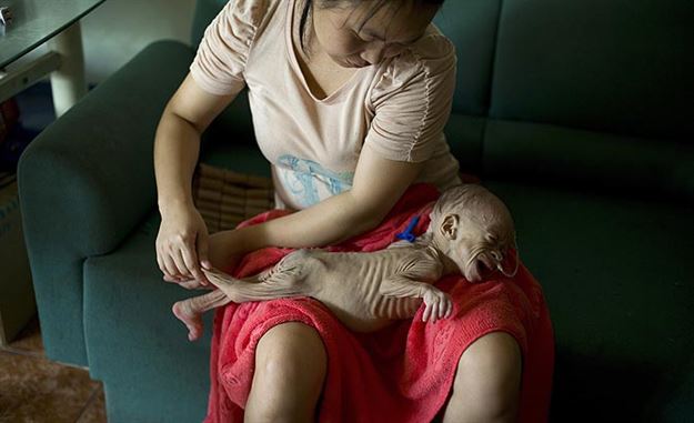 بیماری عجیب نوزاد چینی (+عکس)