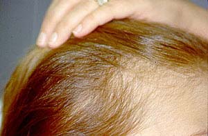 درمان هورمونی ریزش مو مردان