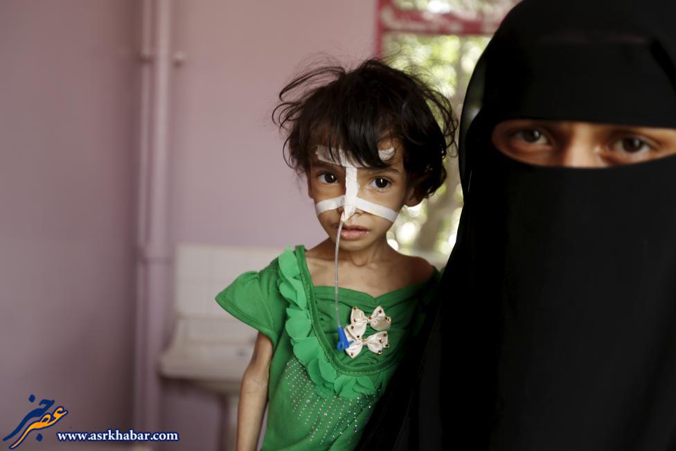 نتیجه تصویری برای کودکان یمنی گرسنگی