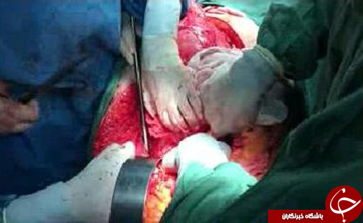 خروج تومور 8 کیلویی از بدن بیمار در بیمارستان خمینی (+ عکس)