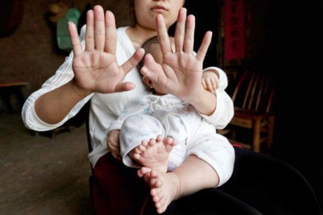 این کودک 31 انگشت دارد (+ عکس)