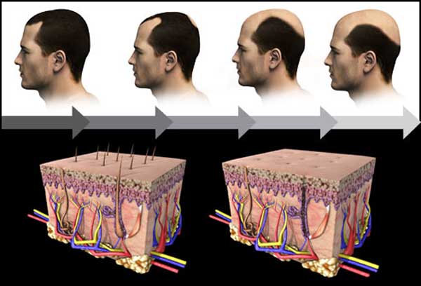 راه حل های درمان ریزش مو در مردان