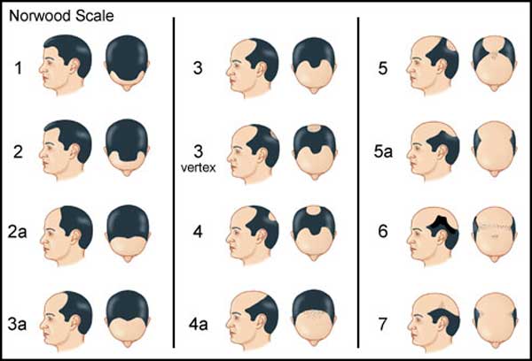 راه حل های درمان ریزش مو در مردان