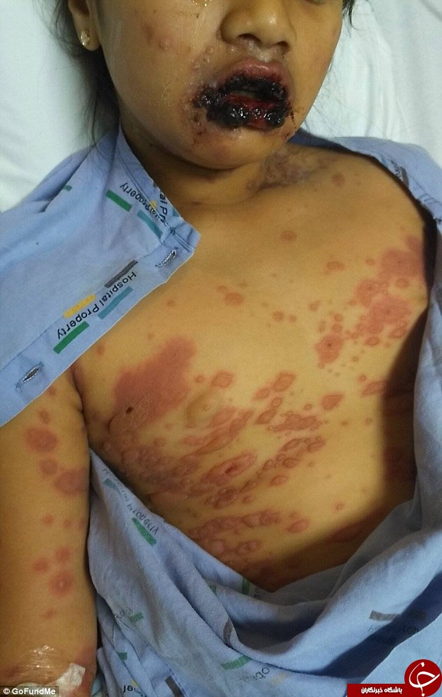 بیماری نادری که کودک 9 ساله را تبدیل به زامبی کرد (+ عکس 16+)