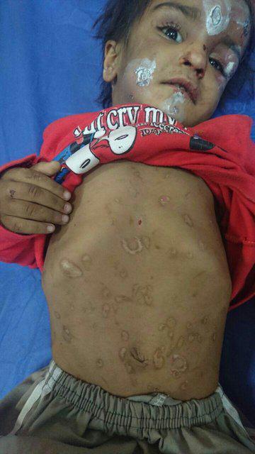 کودک آزاری در رفسنجان/ ستایش در بیمارستان تحت درمان است (+عکس)