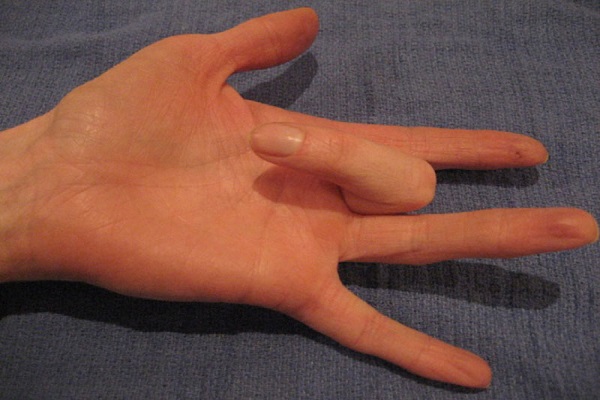 درمان‌هایی ساده برای انگشت ماشه‌ای
