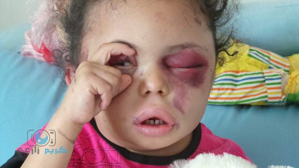 کمپین همدردی با کودک زخمی یمن (+عکس)