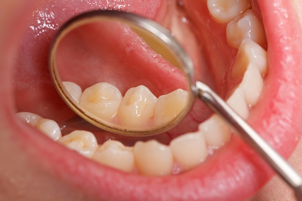 نشانه‌های هشداردهنده اولیه سرطان دهان