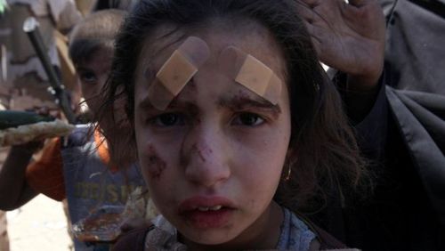 آثار درگیری های مسلحانه بر صورت کودک عراقی