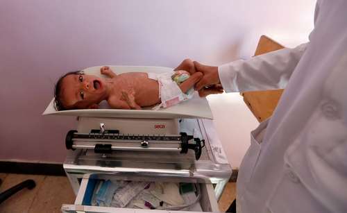 مداوای یک نوزاد مبتلا به سوءتغذیه در بیمارستان سازمان ملل در شهر صنعا یمن/ عکس: خبرگزاری فرانسه