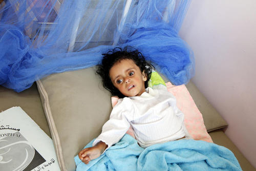 یک کودک دچار سوء تغذیه شدید در بیمارستانی در شهر صنعا یمن/ شینهوا