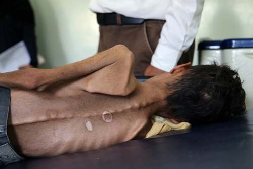 یک پسربچه 10 ساله یمنی مبتلا به سوء تغذیه در بیمارستانی در شهر تعز یمن/ یمن تحت محاصره همه‌جانبه  و حملات عربستان سعودی است./ خبرگزاری فرانسه