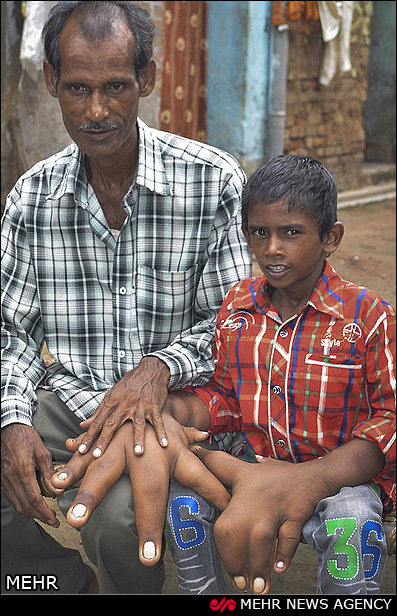 کودک هندی با دستان غول پیکر‎ (عکس)