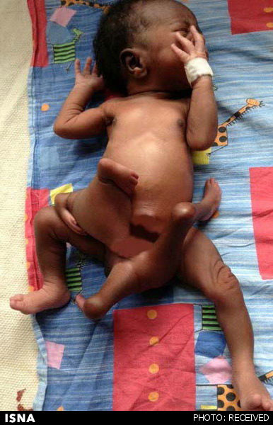 تولد نوزادی با 8 دست و پا! (+عکس)