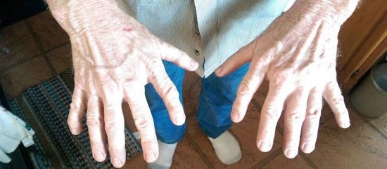 مرد 12 انگشتی! (عکس)