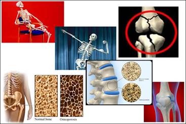 تهیه پودرهای ضدپوکی استخوان توسط محققان ایرانی