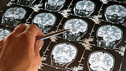 سردرد، اولین علامت تومور مغزی