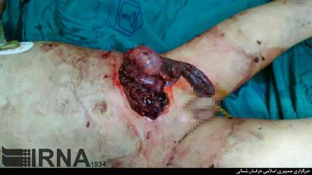 پارگی شکم کودک 5 ساله بجنوردی توسط یک سگ/ حال کودک وخیم است/ فقر خانواده دلیل اعزام نشدن کودک به بیمارستان شیراز