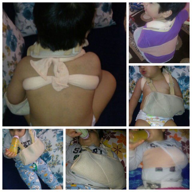 شکستن استخوان ترقوه‌ پسر 3 ساله در مهدکودک/ تایید حادثه کودک‌آزاری (+عکس)