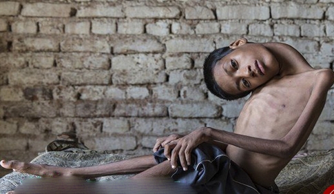 جراحی گردن ۱۸۰ درجه‌ای یک پسر هندی (+عکس)