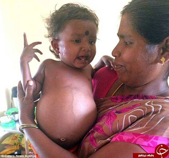 نوزاد دختر هنگام تولد، دوقلو باردار بود! (+عکس)