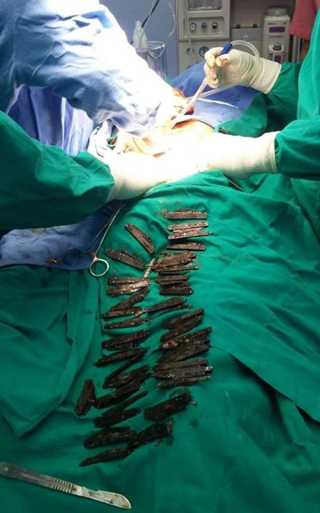 40 چاقوی فلزی از معده بیمار هندی خارج شد (+عکس)