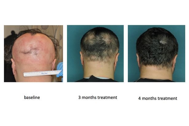 کشف درمان نوعی کچلی