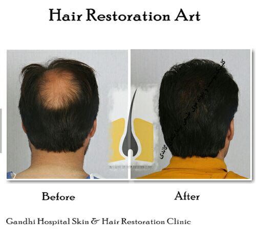 کاشت مو - اطلاعاتی ضروری که باید در مورد جراحی کاشت مو از آن آگاهی داشته باشید