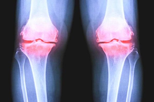 تفاوت‌های بین التهاب مفاصل، آرتروز و پوکی استخوان