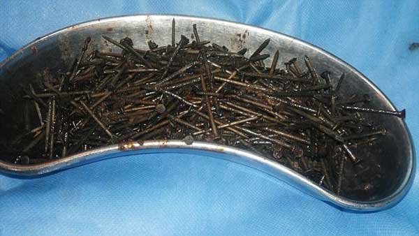 639 میخ در شکم مرد هندی! (+عکس)