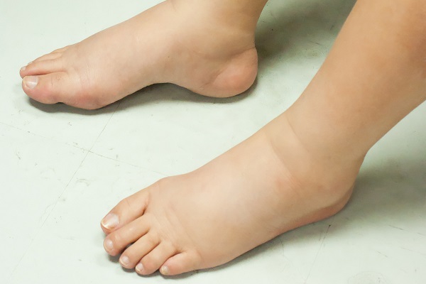 7 دلیل شکل گیری تورم در پاها