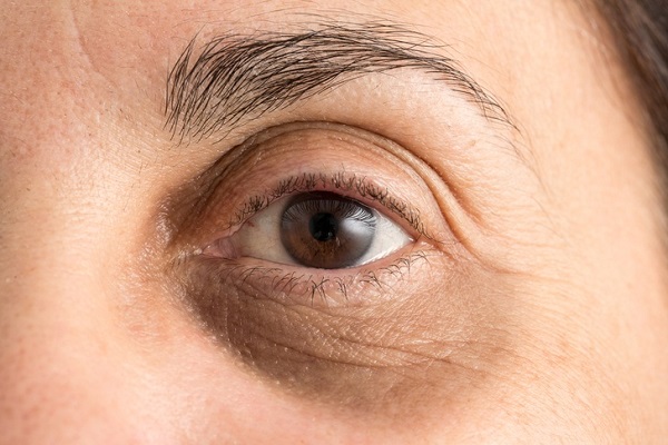 روش‌هایی ساده برای بهبود حلقه‌های تیره زیر چشم
