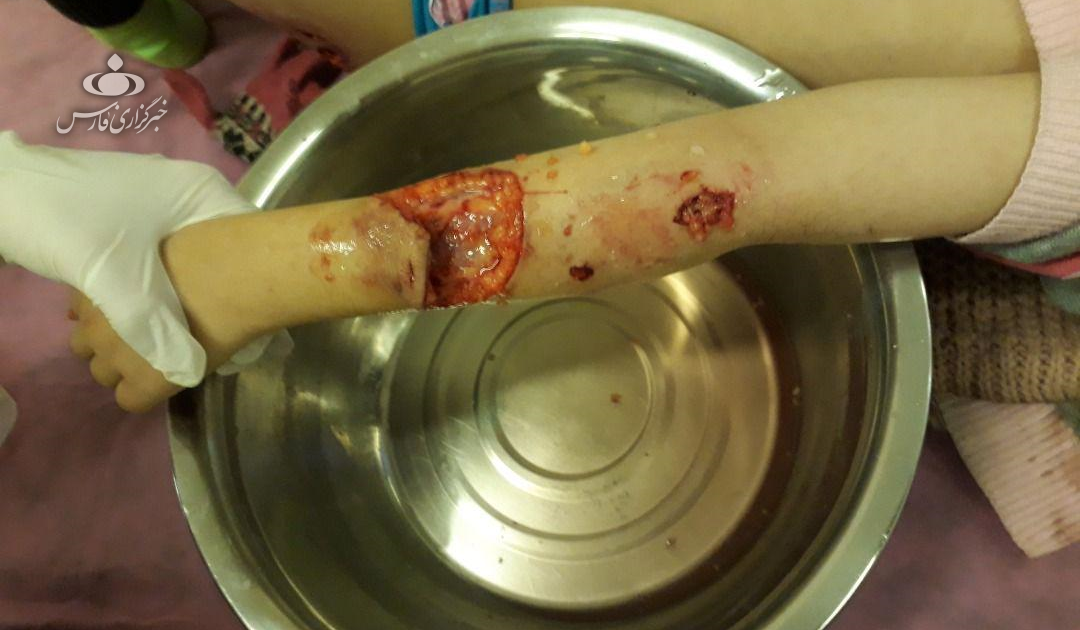 در حاشیه حمله به دختر 10 ساله در لواسان: از گاز گرفتن سگ ها تا دروغ گفتن برخی مسؤولان
