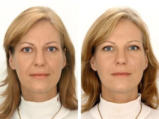 تزریق ژل لب طبیعی در کلینیک پوست و مو رز