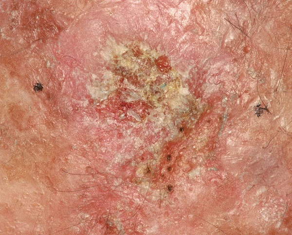 Image result for سرطان پوست
