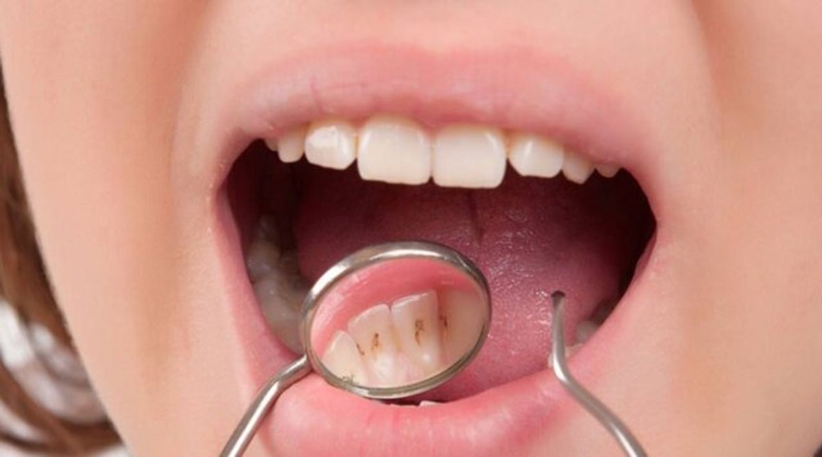چرا دندان بچه‌هایی که به مدارس خصوصی می‌روند، زودتر می‌پوسد؟