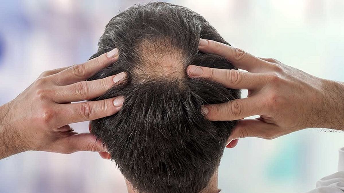آیا ریزش مو از عوارض طبیعی کروناست؟