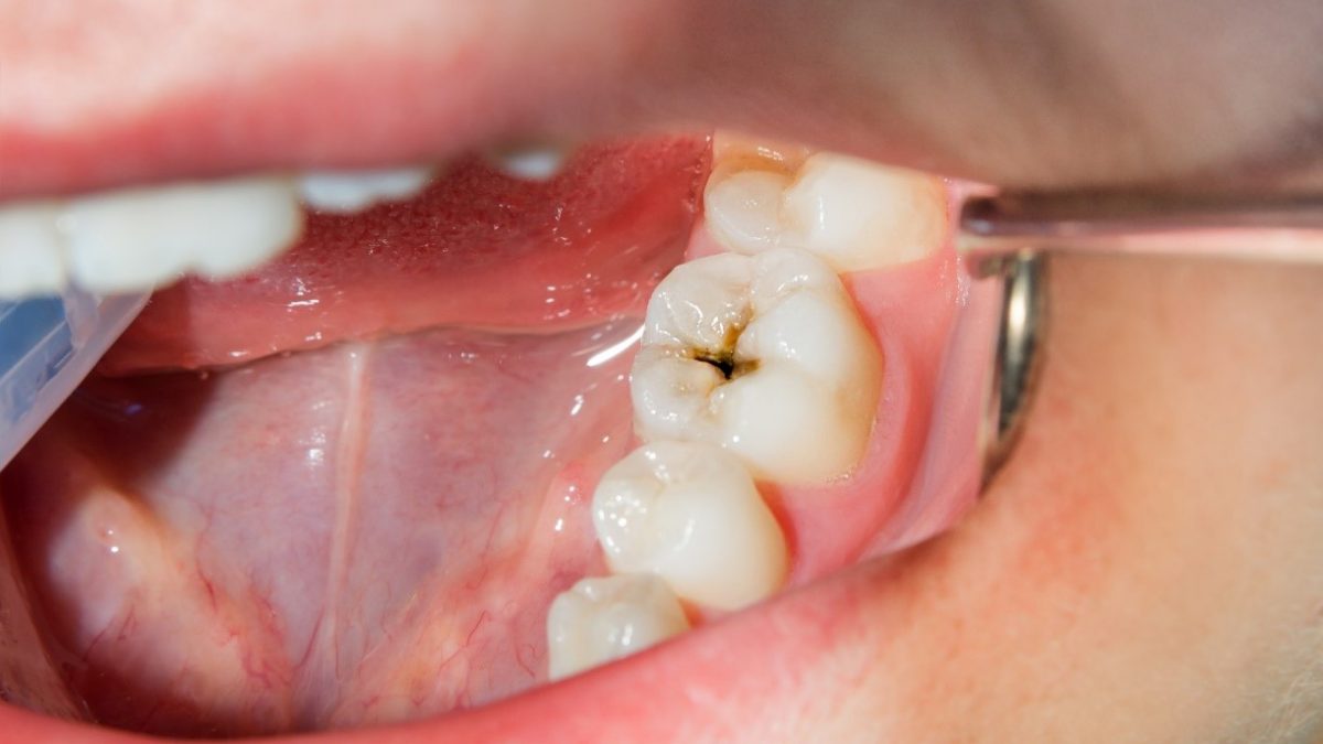 خرابی دندان