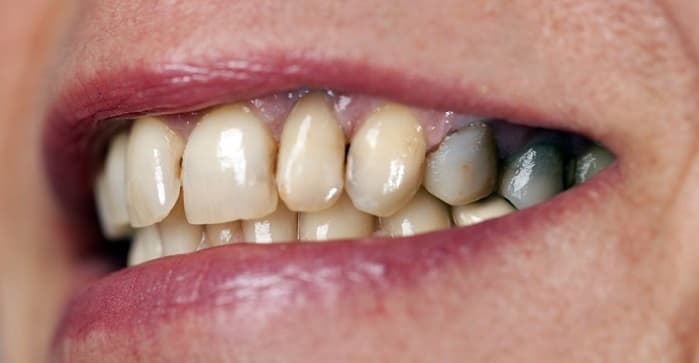 خرابی دندان