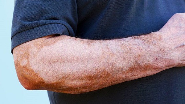 ویتیلیگو چیست و چرا باید به عنوان یک بیماری پوستی مورد توجه قرار گیرد؟