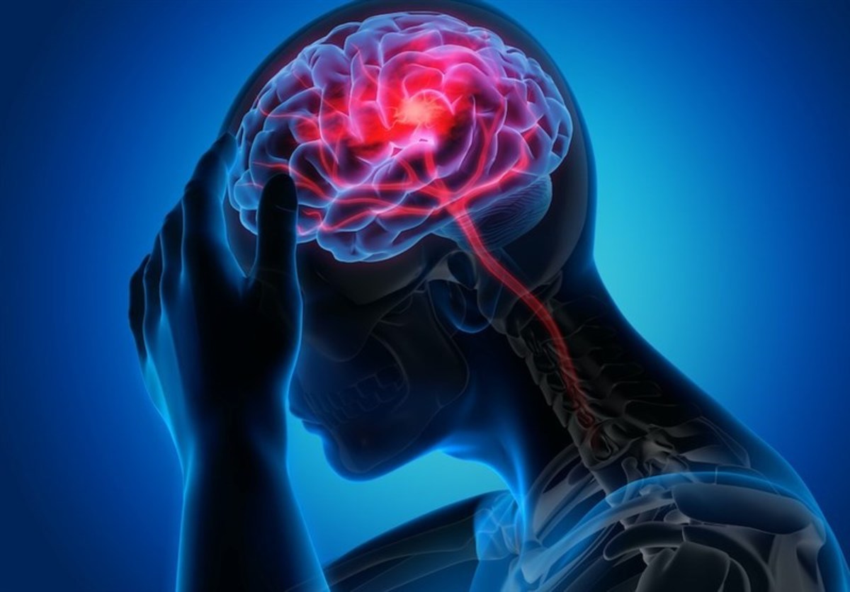 سالانه ۱۸۰ هزار نفر در کشور دچار سکته مغزی می‌شوند