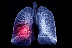سلول‌های سرطان ریه، با کبد چه می کنند؟