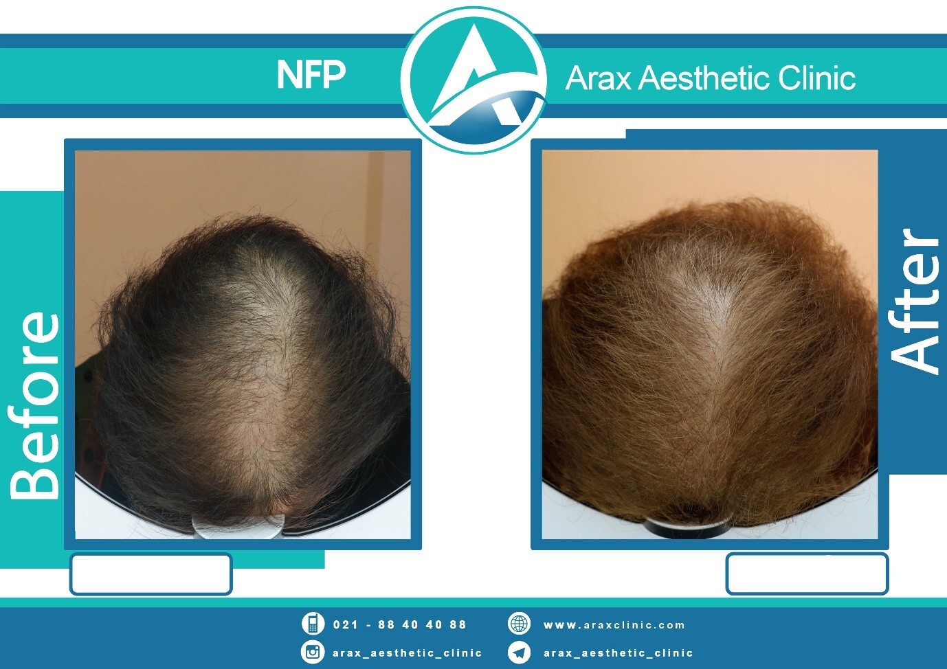 آشنایی با بنیان‌گذار روش درمان ریزش موی NFP در ایران