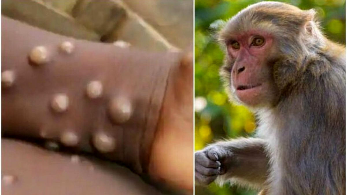 چرا سازمان بهداشت جهانی نام آبله میمون را تغییر می‌دهد؟