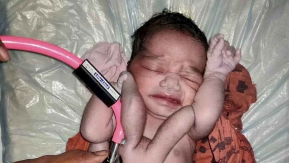 نوزاد عجیب الخلقه ای که «بت» هندی‌ ها شده است (+عکس)