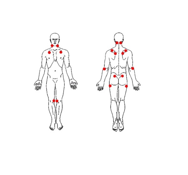 فیبرومیالژی؛ دردی مزمن که شما را رها نمی کند! فیبرومیالژی؛ دردی مزمن که شما را رها نمی کند!