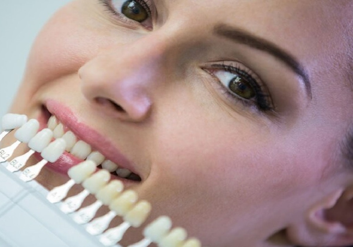 راه های سفید کردن دندان چیست؟